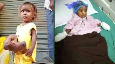 अभिनेता सोनू सूद ने नवादा के 4 हाथ-पैर वाली चौमुखी का सूरत में कराया सफल ऑपरेशन 1 Actor philanthropist Sonu Sood successfully operated four hand legged four legged from Nawada in Surat