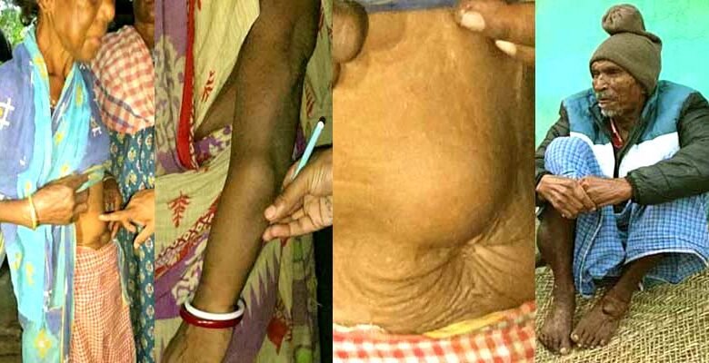 The dark chapter of Jadugoda Hundreds of lives are being lost in the glow of uranium 6